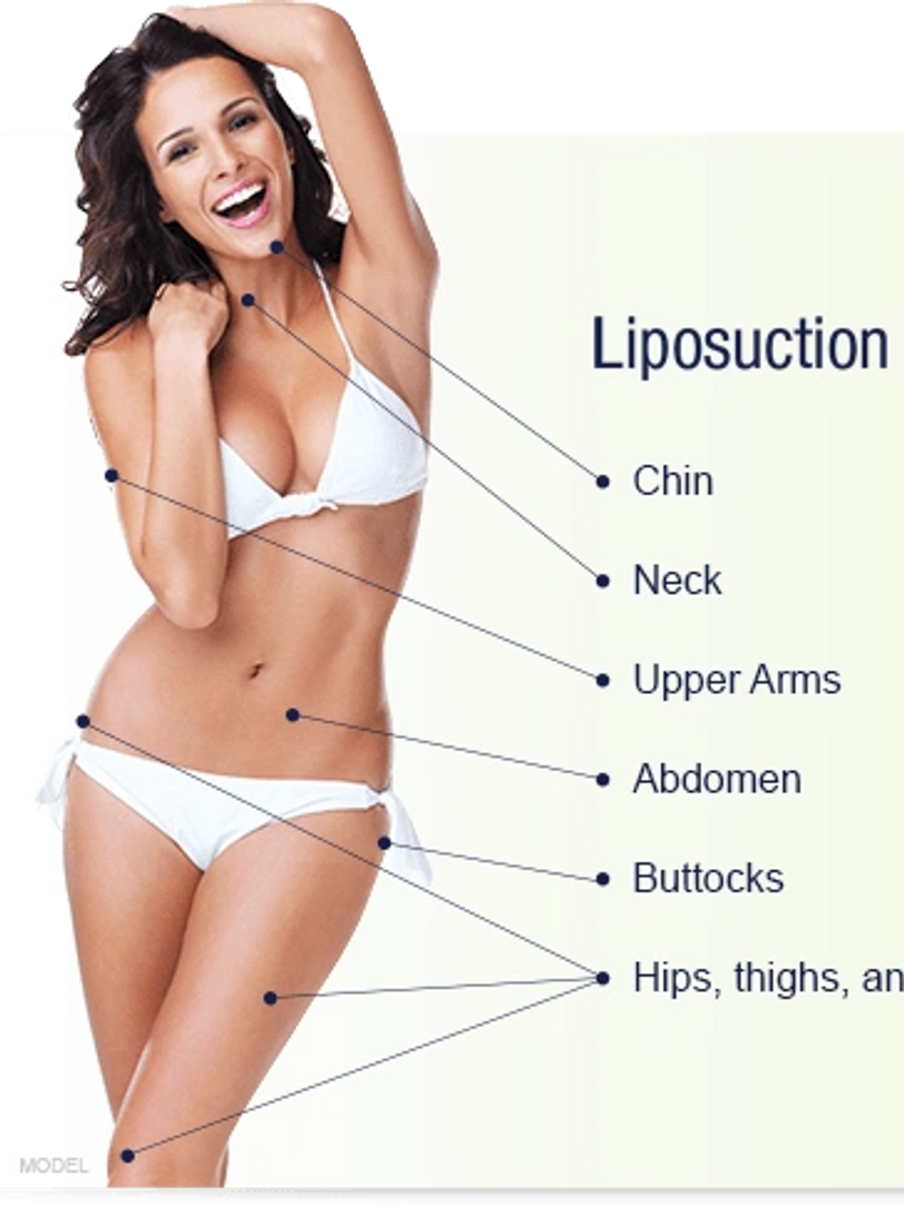Liposculpting with BodyTite Liposuction in Toronto Omni Surgery